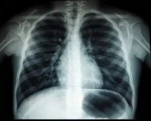 Lung Cancer Treatment in Germany: A Global Leader in Advanced Medical Care lung cancer tratment in germany scaled